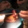 Doctors perform organ transplant