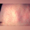 Measles, health Measles (Photo: Wikimedia Commons)