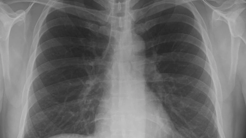 X-rays, xray Photo: wikimedia