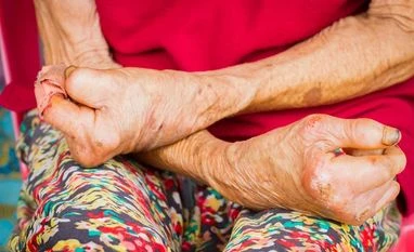 India accounts for over half of world's new leprosy patients, shows data Leprosy