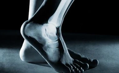 We broke the same bone. My recovery was a breeze, hers an ordeal. Why? Photo: iSTOCK