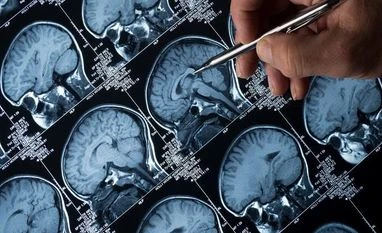 Repeated infections increase risk of neurodegenerative diseases: Study Alzheimer's disease