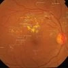 Big Tech uses AI to arrest blindness among India's burgeoning diabetics