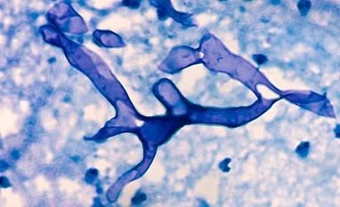 Maharashtra to compile database of mucormycosis to assess its spread mucormycosis