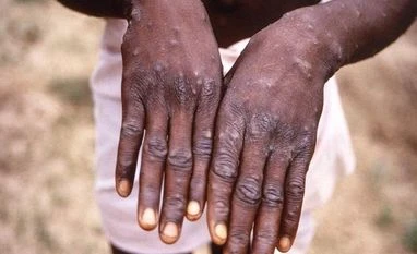 Monkeypox outbreak slowly decreased in US, officials urge caution Monkeypox symptoms