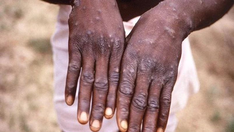 Monkeypox symptoms Monkeypox symptoms