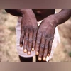 Monkeypox symptoms Monkeypox symptoms