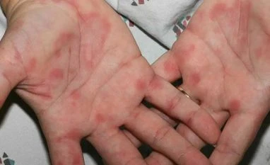 Tomato Flu not related to SARS-CoV-2, Centre sent advisory to states Tomato virus, Tomato Flu