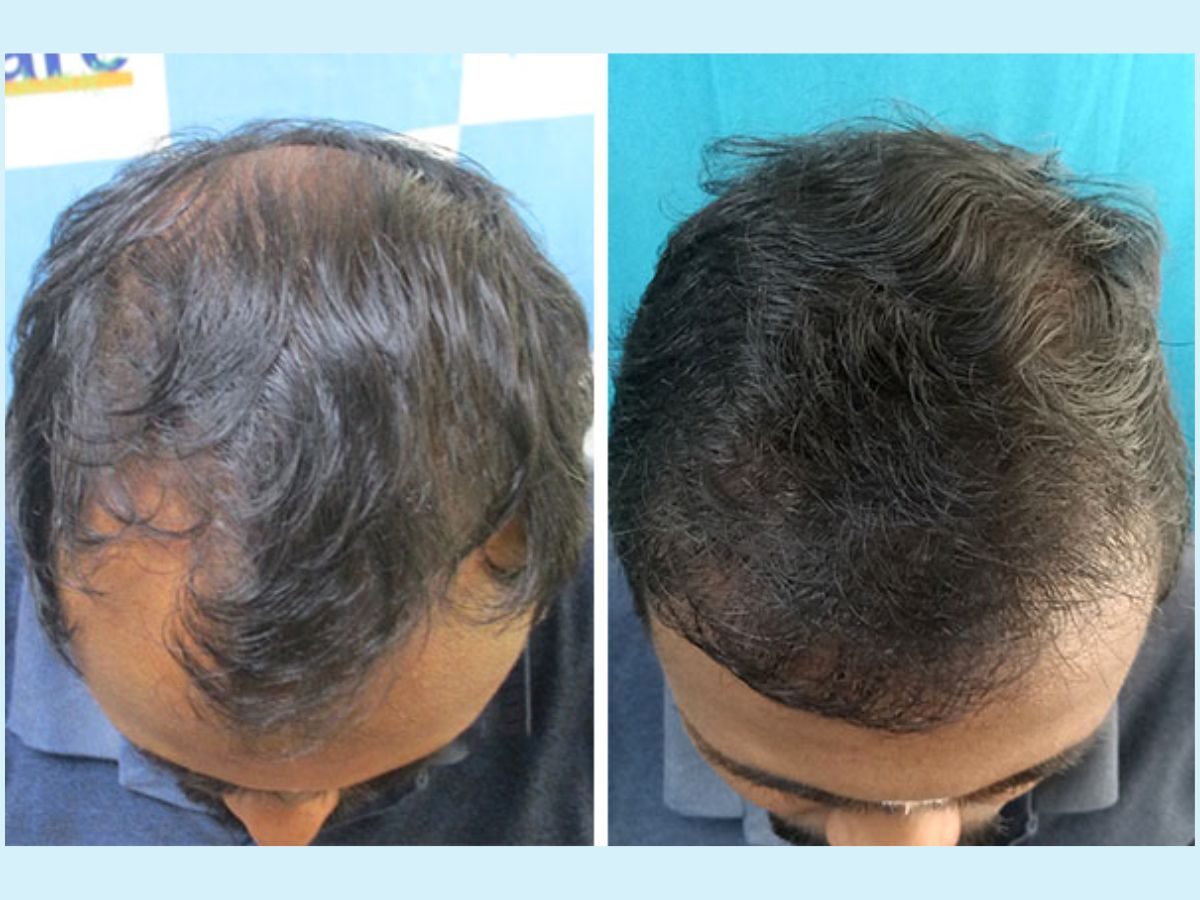 Details 68 Can Hair Thinning Be Reversed Vova edu vn