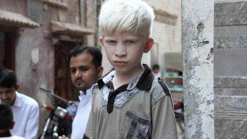 International Albinism Awareness Day 2023 International Albinism Awareness Day 2023