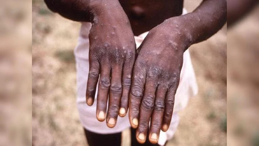 S'pore begins screening incoming passengers at airports for mpox symptoms | World News Mpox