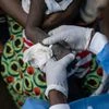 Mpox in Congo