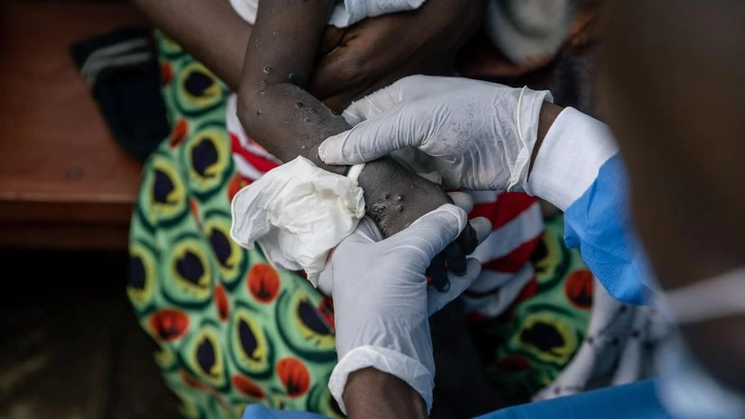 Mpox in Congo Mpox in Congo