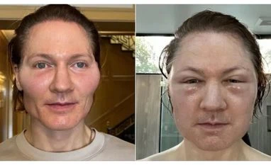 Tech millionaire's 'baby face' experiment goes wrong, face 'blows up' Bryan Johnson