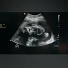 Fetus, baby, ultrasound Fetus, baby, ultrasound representative image| Photo by Pavel Danilyuk on Pexels