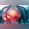 What is a double heart attack and why the second one is often more fatal