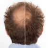 hair loss treatment, baldness cure