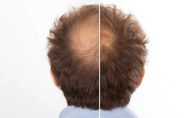 Could this be the end of baldness? Scientists test breakthrough hair drug hair loss treatment, baldness cure