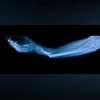 Bone glue breakthrough: Chinese scientists heal fractures in 3 minutes bone glue, fracture healing