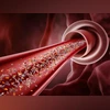 Tiny plastics in arteries might heighten heart attack risk, experts warn