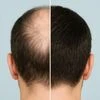 hair loss breakthrough, male-pattern baldness, hair growth
