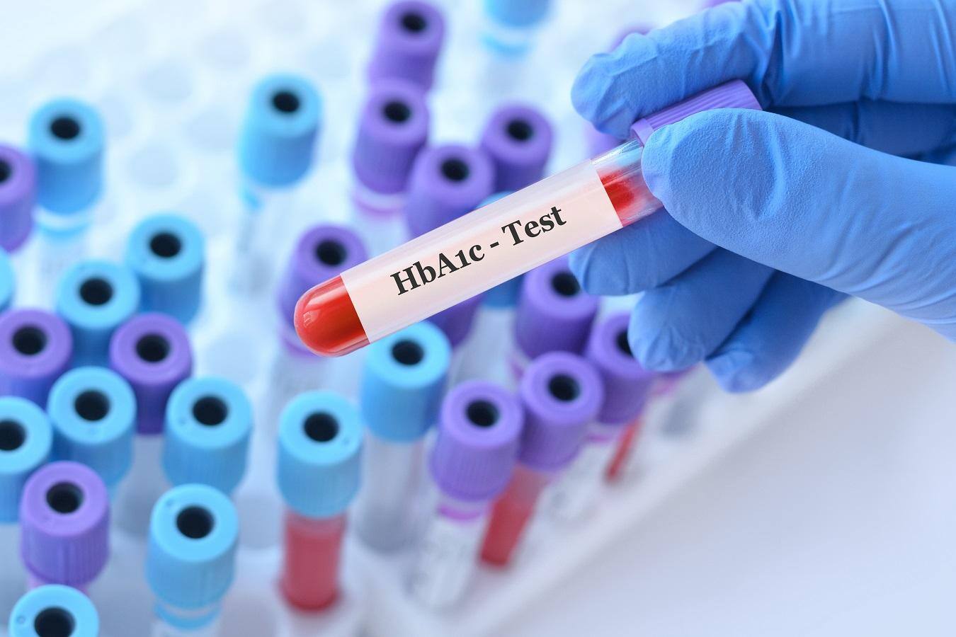 HbA1c alone may misdiagnose diabetes in India, experts warn after new Lancet review