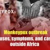 Monkeypox outbreak: Causes, symptoms, and cases outside Africa